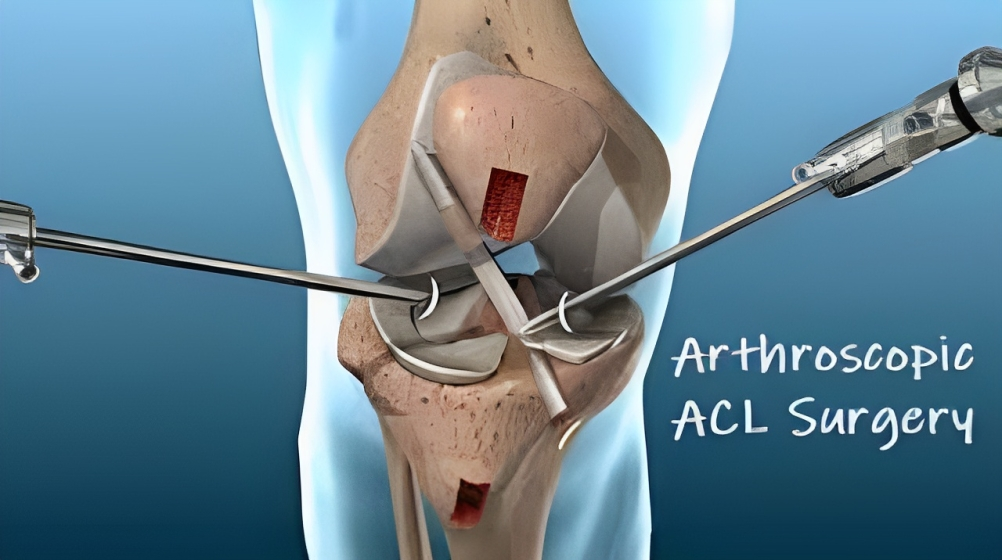 Arthroscopic anterior cruciate ligament reconstruction: A Minimally Invasive Solution for Knee Injuries